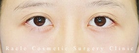 眼瞼下垂(挙筋腱膜前転法)の症例写真02 Before