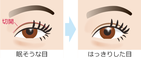 眼瞼下垂(挙筋腱膜前転法)　施術前→施術後イメージ