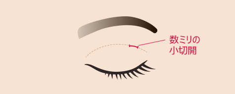 目の上の脂肪取り(マイクロカット法)　施術イメージ01