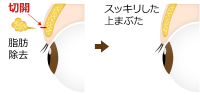 目の上の脂肪取り(マイクロカット法)　施術イメージ02
