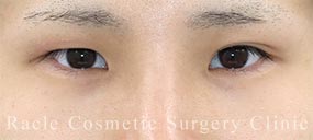 全切開法二重術の症例写真06 Before