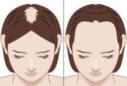 女性の薄毛、FAGA(びまん性脱毛症)　イメージ