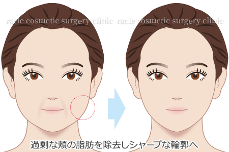 バッカルファット除去 過剰な頬の脂肪を除去しシャープな輪郭へ