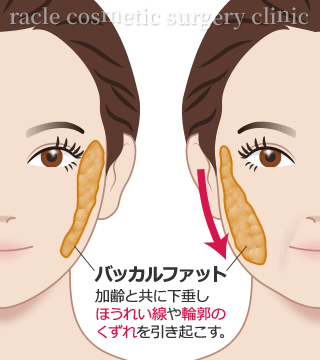 バッカルファット　垂れ下がるイメージ