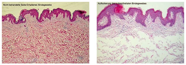 LDM治療前後の皮膚組織