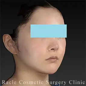 LipoLife(ライポライフ)脂肪吸引+ナチュラルフェイスリフトの症例写真05 After