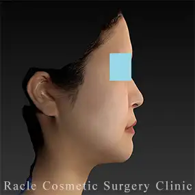 LipoLife(ライポライフ)脂肪吸引+ナチュラルフェイスリフトの症例写真06 Before