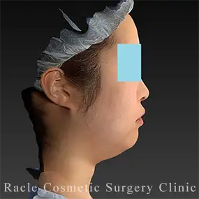 LipoLife(ライポライフ)脂肪吸引の症例写真13 Before