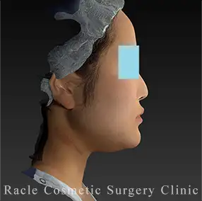 LipoLife(ライポライフ)脂肪吸引の症例写真02 Before