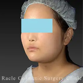 LipoLife(ライポライフ)脂肪吸引の症例写真02 Before