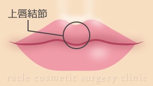 上唇結節増大(真皮脂肪移植) イメージ