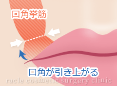 口角挙上の施術-口角挙筋の縫縮イメージ