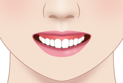 歯茎が露出する　イメージ