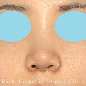 耳介軟骨移植(鼻尖)の症例写真05 After