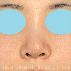 耳介軟骨移植(鼻尖)の症例写真05 Before