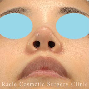 耳介軟骨移植(鼻尖)の症例写真06 After