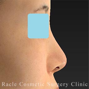 耳介軟骨移植(鼻尖)の症例写真07 Before