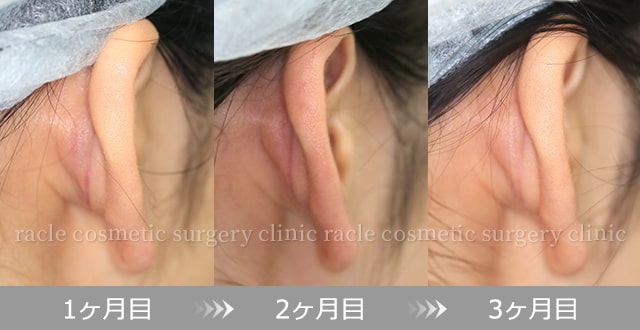 耳介軟骨移植　傷の経過イメージ 1ヶ月目～3ヶ月目