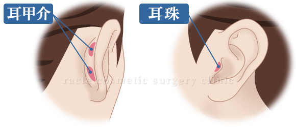 耳介軟骨移植(鼻尖)　施術イメージ01