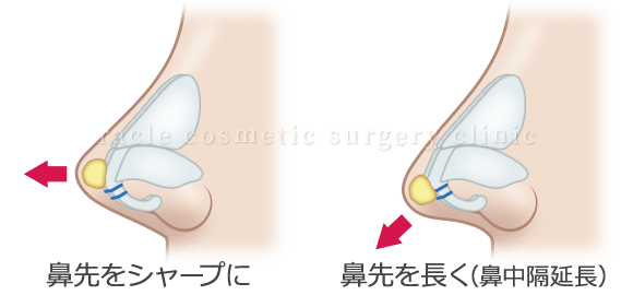 鼻尖軟骨形成(鼻尖縮小＋α法)　施術イメージ02