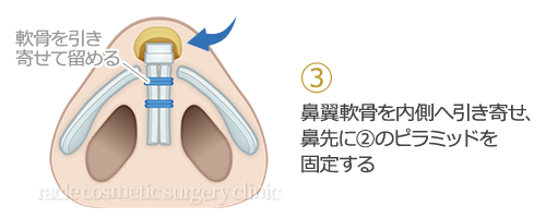 鼻尖縮小+α法 術式イメージ03