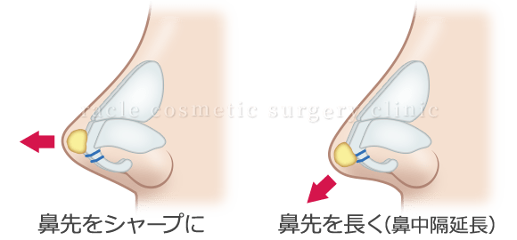 鼻尖軟骨形成(鼻尖縮小＋α法)　施術イメージ02