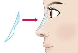 プロテーゼによる隆鼻術　イメージ