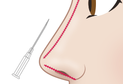 糸による隆鼻術　イメージ