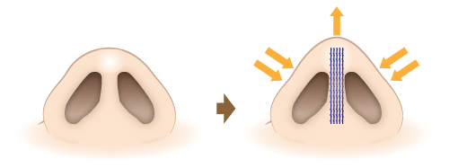 HANAKO形成術(隆鼻&鼻先形成術)　施術イメージ