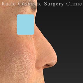 ワシ鼻修正の症例写真04 After