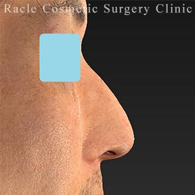 ワシ鼻修正の症例写真04 Before