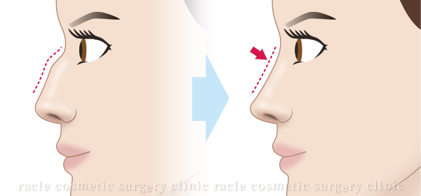 ワシ鼻修正　施術後イメージ