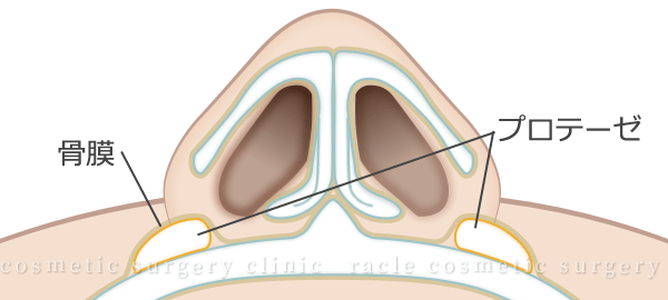 鼻翼基部プロテーゼの骨膜下挿入イメージ