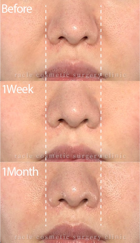 貴族手術の鼻の幅変化経過写真(術前～1ヶ月目)
