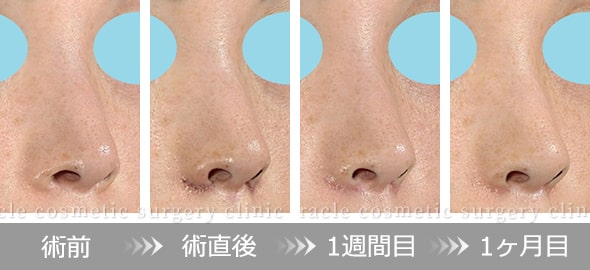 小鼻縮小＋α法のダウンタイム　イメージ