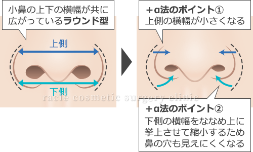 鼻の穴が目立たない小鼻縮小+α法　術式イメージ