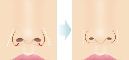 小鼻縮小の効果　術イメージ