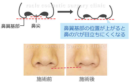 鼻の穴が目立たない小鼻縮小　術式イメージ