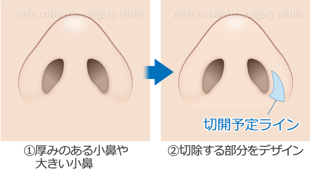 鼻翼挙上術の施術方法　説明イラスト01