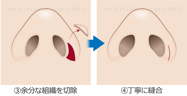 鼻翼挙上術の施術方法　説明イラスト02