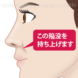 貴族手術(鼻翼基部プロテーゼ)の施術効果イメージ
