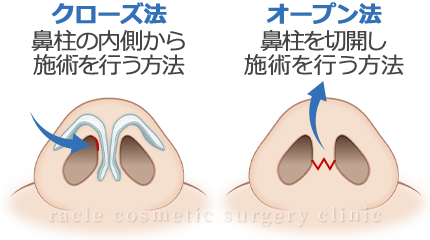 鼻尖縮小(鼻尖形成) クローズ法とオープン法　イメージ