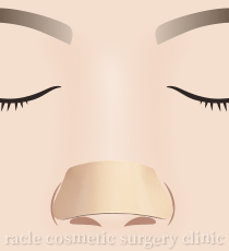 鼻尖縮小(鼻尖形成)　術後の固定イメージイラスト
