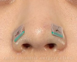 鼻孔縁下降術の術後の固定 イメージ