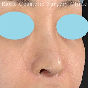 鼻孔縁下降術の症例写真03 Before