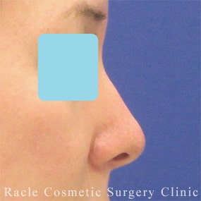鼻孔縁下降術の症例写真06 Before