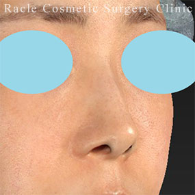 鼻孔縁下降術の症例写真13 Before