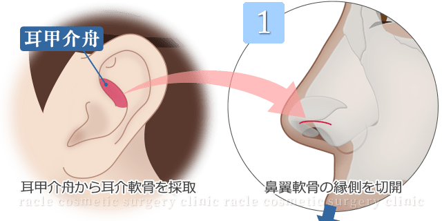 鼻孔縁下降術　施術イメージ01