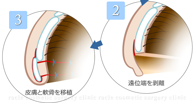 鼻孔縁下降術　施術イメージ01