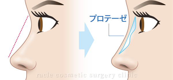 プロテーゼ隆鼻術　施術イメージ